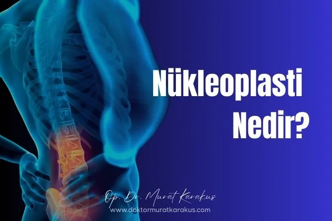nükleoplasti nedir